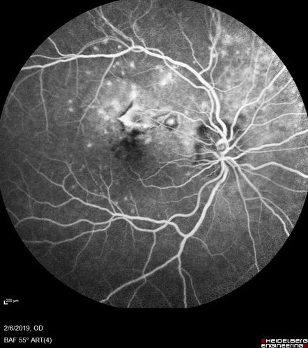 Punctate Inner Choroidopathy and Choroidal Neovascular Membrane
27 year old female with vision loss for 4 months. VA was 20/200.  She had a CNVM which was extrafoveal with no subretinal fluid.  Her vision improved over 6 months to 20/50 with Ranibizumab injections (she might have improved without treatment)
