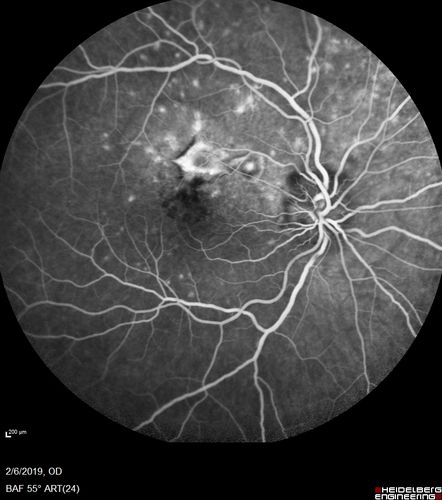 Punctate Inner Choroidopathy and Choroidal Neovascular Membrane
27 year old female with vision loss for 4 months. VA was 20/200.  She had a CNVM which was extrafoveal with no subretinal fluid.  Her vision improved over 6 months to 20/50 with Ranibizumab injections (she might have improved without treatment)
