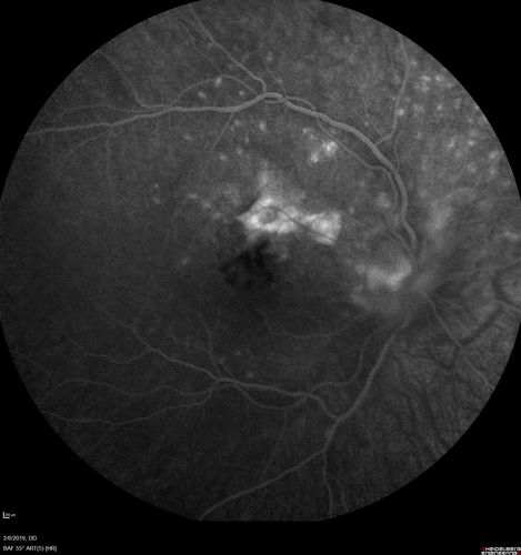 Punctate Inner Choroidopathy and Choroidal Neovascular Membrane
27 year old female with vision loss for 4 months. VA was 20/200.  She had a CNVM which was extrafoveal with no subretinal fluid.  Her vision improved over 6 months to 20/50 with Ranibizumab injections (she might have improved without treatment)
