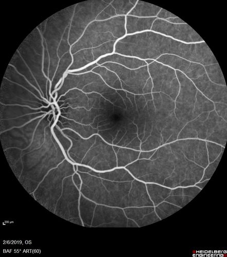 Punctate Inner Choroidopathy and Choroidal Neovascular Membrane
27 year old female with vision loss for 4 months. VA was 20/200.  She had a CNVM which was extrafoveal with no subretinal fluid.  Her vision improved over 6 months to 20/50 with Ranibizumab injections (she might have improved without treatment)
