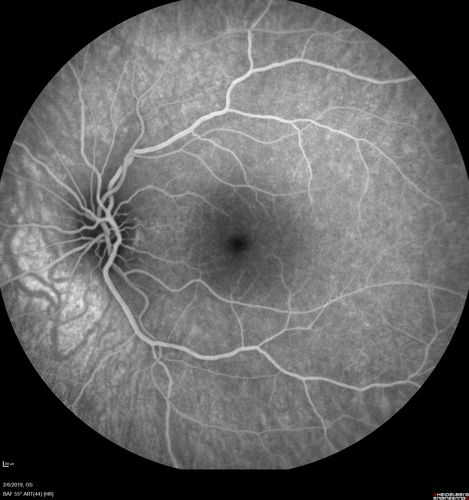 Punctate Inner Choroidopathy and Choroidal Neovascular Membrane
27 year old female with vision loss for 4 months. VA was 20/200.  She had a CNVM which was extrafoveal with no subretinal fluid.  Her vision improved over 6 months to 20/50 with Ranibizumab injections (she might have improved without treatment)
