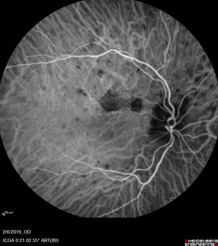 Punctate Inner Choroidopathy and Choroidal Neovascular Membrane
27 year old female with vision loss for 4 months. VA was 20/200.  She had a CNVM which was extrafoveal with no subretinal fluid.  Her vision improved over 6 months to 20/50 with Ranibizumab injections (she might have improved without treatment)

