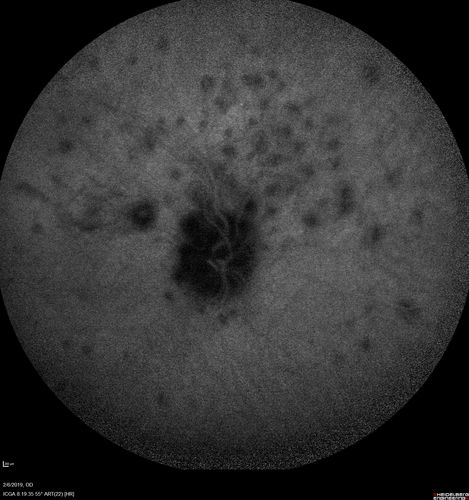 Punctate Inner Choroidopathy and Choroidal Neovascular Membrane
27 year old female with vision loss for 4 months. VA was 20/200.  She had a CNVM which was extrafoveal with no subretinal fluid.  Her vision improved over 6 months to 20/50 with Ranibizumab injections (she might have improved without treatment)
