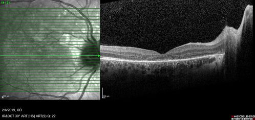 Punctate Inner Choroidopathy and Choroidal Neovascular Membrane
27 year old female with vision loss for 4 months. VA was 20/200.  She had a CNVM which was extrafoveal with no subretinal fluid.  Her vision improved over 6 months to 20/50 with Ranibizumab injections (she might have improved without treatment)
