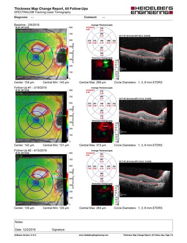 Punctate Inner Choroidopathy and Choroidal Neovascular Membrane
27 year old female with vision loss for 4 months. VA was 20/200.  She had a CNVM which was extrafoveal with no subretinal fluid.  Her vision improved over 6 months to 20/50 with Ranibizumab injections (she might have improved without treatment)
