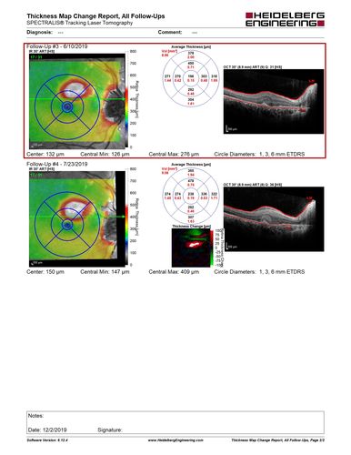 Punctate Inner Choroidopathy and Choroidal Neovascular Membrane
27 year old female with vision loss for 4 months. VA was 20/200.  She had a CNVM which was extrafoveal with no subretinal fluid.  Her vision improved over 6 months to 20/50 with Ranibizumab injections (she might have improved without treatment)
