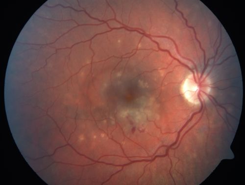 Punctate Inner Choroidopathy - PIC and Choroidal Neovascular Membrane - Right Eye - Color Fundus Photograph
34-year-old woman with a change in vision in the right eye about eight days ago.  Her vision was hazy and she saw waviness in the vision.  She does have a history of aches and pains and she was diagnosed with Sjogrenâ€™s and 2 months ago she had some fevers and some sinus drainage and that went on for about two months.  She is a moderate myope.    OD 20/25, OS 20/20.   
