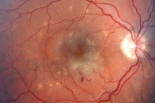 Punctate Inner Choroidopathy - PIC and Choroidal Neovascular Membrane - Right Eye - Color Fundus Photograph
34-year-old woman with a change in vision in the right eye about eight days ago.  Her vision was hazy and she saw waviness in the vision.  She does have a history of aches and pains and she was diagnosed with Sjogrenâ€™s and 2 months ago she had some fevers and some sinus drainage and that went on for about two months.  She is a moderate myope.    OD 20/25, OS 20/20.   
