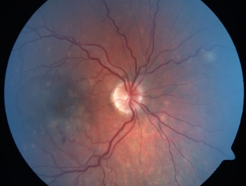 Punctate Inner Choroidopathy - PIC and Choroidal Neovascular Membrane - Right Eye - Color Fundus Photograph
34-year-old woman with a change in vision in the right eye about eight days ago.  Her vision was hazy and she saw waviness in the vision.  She does have a history of aches and pains and she was diagnosed with Sjogrenâ€™s and 2 months ago she had some fevers and some sinus drainage and that went on for about two months.  She is a moderate myope.    OD 20/25, OS 20/20.   
