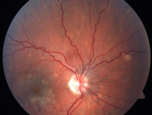 Punctate Inner Choroidopathy - PIC and Choroidal Neovascular Membrane - Right Eye - Color Fundus Photograph
34-year-old woman with a change in vision in the right eye about eight days ago.  Her vision was hazy and she saw waviness in the vision.  She does have a history of aches and pains and she was diagnosed with Sjogrenâ€™s and 2 months ago she had some fevers and some sinus drainage and that went on for about two months.  She is a moderate myope.    OD 20/25, OS 20/20.   
