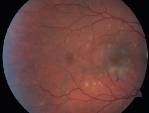 Punctate Inner Choroidopathy - PIC and Choroidal Neovascular Membrane - Right Eye - Color Fundus Photograph
34-year-old woman with a change in vision in the right eye about eight days ago.  Her vision was hazy and she saw waviness in the vision.  She does have a history of aches and pains and she was diagnosed with Sjogrenâ€™s and 2 months ago she had some fevers and some sinus drainage and that went on for about two months.  She is a moderate myope.    OD 20/25, OS 20/20.   
