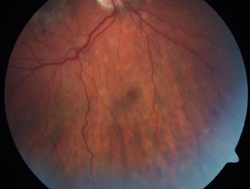 Punctate Inner Choroidopathy - PIC and Choroidal Neovascular Membrane - Right Eye - Color Fundus Photograph
34-year-old woman with a change in vision in the right eye about eight days ago.  Her vision was hazy and she saw waviness in the vision.  She does have a history of aches and pains and she was diagnosed with Sjogrenâ€™s and 2 months ago she had some fevers and some sinus drainage and that went on for about two months.  She is a moderate myope.    OD 20/25, OS 20/20.   
