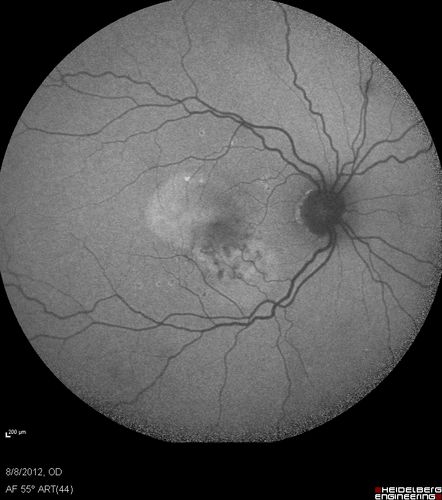 Punctate Inner Choroidopathy - PIC and Choroidal Neovascular Membrane - Right Eye - Fundus Autofluorescence
34-year-old woman with a change in vision in the right eye about eight days ago.  Her vision was hazy and she saw waviness in the vision.  She does have a history of aches and pains and she was diagnosed with Sjogrenâ€™s and 2 months ago she had some fevers and some sinus drainage and that went on for about two months.  She is a moderate myope.    OD 20/25, OS 20/20.   
