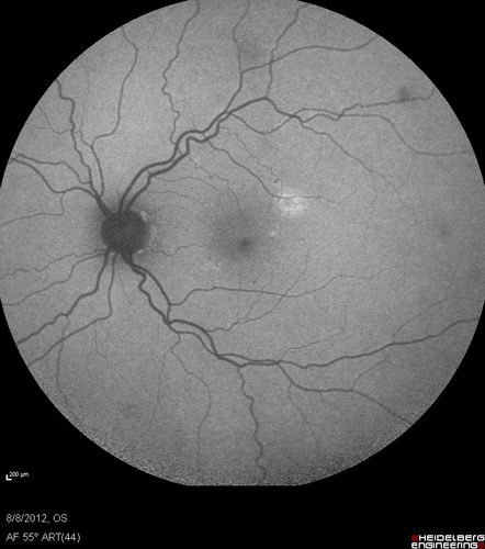 Punctate Inner Choroidopathy - PIC and Choroidal Neovascular Membrane - Right Eye - Fundus Autofluorescence
34-year-old woman with a change in vision in the right eye about eight days ago.  Her vision was hazy and she saw waviness in the vision.  She does have a history of aches and pains and she was diagnosed with Sjogrenâ€™s and 2 months ago she had some fevers and some sinus drainage and that went on for about two months.  She is a moderate myope.    OD 20/25, OS 20/20.   
