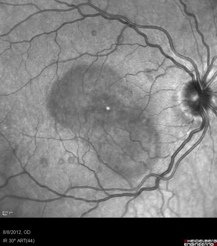 Punctate Inner Choroidopathy - PIC and Choroidal Neovascular Membrane - Right Eye - InfraRed Photo
34-year-old woman with a change in vision in the right eye about eight days ago.  Her vision was hazy and she saw waviness in the vision.  She does have a history of aches and pains and she was diagnosed with Sjogrenâ€™s and 2 months ago she had some fevers and some sinus drainage and that went on for about two months.  She is a moderate myope.    OD 20/25, OS 20/20.   
