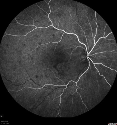 Punctate Inner Choroidopathy - PIC and Choroidal Neovascular Membrane - Right Eye - Fluorescein Angiogram
34-year-old woman with a change in vision in the right eye about eight days ago.  Her vision was hazy and she saw waviness in the vision.  She does have a history of aches and pains and she was diagnosed with Sjogrenâ€™s and 2 months ago she had some fevers and some sinus drainage and that went on for about two months.  She is a moderate myope.    OD 20/25, OS 20/20.   
