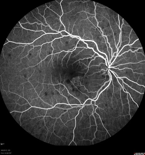Punctate Inner Choroidopathy - PIC and Choroidal Neovascular Membrane - Right Eye - Fluorescein Angiogram
34-year-old woman with a change in vision in the right eye about eight days ago.  Her vision was hazy and she saw waviness in the vision.  She does have a history of aches and pains and she was diagnosed with Sjogrenâ€™s and 2 months ago she had some fevers and some sinus drainage and that went on for about two months.  She is a moderate myope.    OD 20/25, OS 20/20.   
