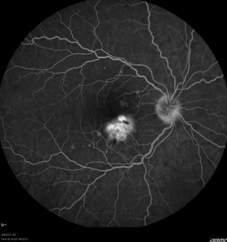 Punctate Inner Choroidopathy - PIC and Choroidal Neovascular Membrane - Right Eye - Fluorescein Angiogram
34-year-old woman with a change in vision in the right eye about eight days ago.  Her vision was hazy and she saw waviness in the vision.  She does have a history of aches and pains and she was diagnosed with Sjogrenâ€™s and 2 months ago she had some fevers and some sinus drainage and that went on for about two months.  She is a moderate myope.    OD 20/25, OS 20/20.   

