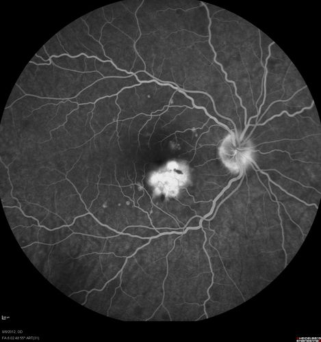 Punctate Inner Choroidopathy - PIC and Choroidal Neovascular Membrane - Right Eye - Fluorescein Angiogram
34-year-old woman with a change in vision in the right eye about eight days ago.  Her vision was hazy and she saw waviness in the vision.  She does have a history of aches and pains and she was diagnosed with Sjogrenâ€™s and 2 months ago she had some fevers and some sinus drainage and that went on for about two months.  She is a moderate myope.    OD 20/25, OS 20/20.   
