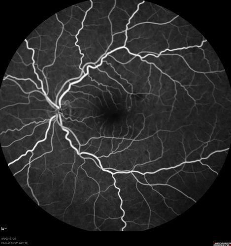Punctate Inner Choroidopathy - PIC and Choroidal Neovascular Membrane - Right Eye - Fluorescein Angiogram
34-year-old woman with a change in vision in the right eye about eight days ago.  Her vision was hazy and she saw waviness in the vision.  She does have a history of aches and pains and she was diagnosed with Sjogrenâ€™s and 2 months ago she had some fevers and some sinus drainage and that went on for about two months.  She is a moderate myope.    OD 20/25, OS 20/20.   
