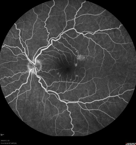 Punctate Inner Choroidopathy - PIC and Choroidal Neovascular Membrane - Right Eye - Fluorescein Angiogram
34-year-old woman with a change in vision in the right eye about eight days ago.  Her vision was hazy and she saw waviness in the vision.  She does have a history of aches and pains and she was diagnosed with Sjogrenâ€™s and 2 months ago she had some fevers and some sinus drainage and that went on for about two months.  She is a moderate myope.    OD 20/25, OS 20/20.   

