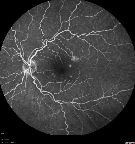 Punctate Inner Choroidopathy - PIC and Choroidal Neovascular Membrane - Right Eye - Fluorescein Angiogram
34-year-old woman with a change in vision in the right eye about eight days ago.  Her vision was hazy and she saw waviness in the vision.  She does have a history of aches and pains and she was diagnosed with Sjogrenâ€™s and 2 months ago she had some fevers and some sinus drainage and that went on for about two months.  She is a moderate myope.    OD 20/25, OS 20/20.   

