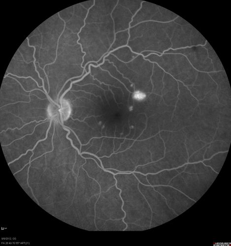 Punctate Inner Choroidopathy - PIC and Choroidal Neovascular Membrane - Right Eye - Fluorescein Angiogram
34-year-old woman with a change in vision in the right eye about eight days ago.  Her vision was hazy and she saw waviness in the vision.  She does have a history of aches and pains and she was diagnosed with Sjogrenâ€™s and 2 months ago she had some fevers and some sinus drainage and that went on for about two months.  She is a moderate myope.    OD 20/25, OS 20/20.   
