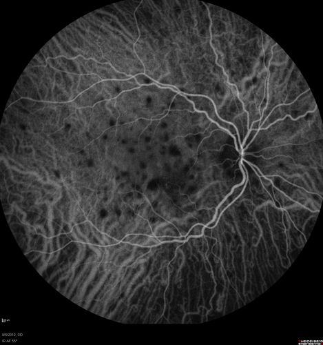 Punctate Inner Choroidopathy - PIC and Choroidal Neovascular Membrane - Right Eye - ICG Angiogram
34-year-old woman with a change in vision in the right eye about eight days ago.  Her vision was hazy and she saw waviness in the vision.  She does have a history of aches and pains and she was diagnosed with Sjogrenâ€™s and 2 months ago she had some fevers and some sinus drainage and that went on for about two months.  She is a moderate myope.    OD 20/25, OS 20/20.   
