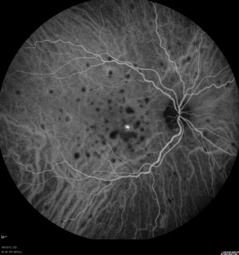 Punctate Inner Choroidopathy - PIC and Choroidal Neovascular Membrane - Right Eye - ICG Angiogram
34-year-old woman with a change in vision in the right eye about eight days ago.  Her vision was hazy and she saw waviness in the vision.  She does have a history of aches and pains and she was diagnosed with Sjogrenâ€™s and 2 months ago she had some fevers and some sinus drainage and that went on for about two months.  She is a moderate myope.    OD 20/25, OS 20/20.   
