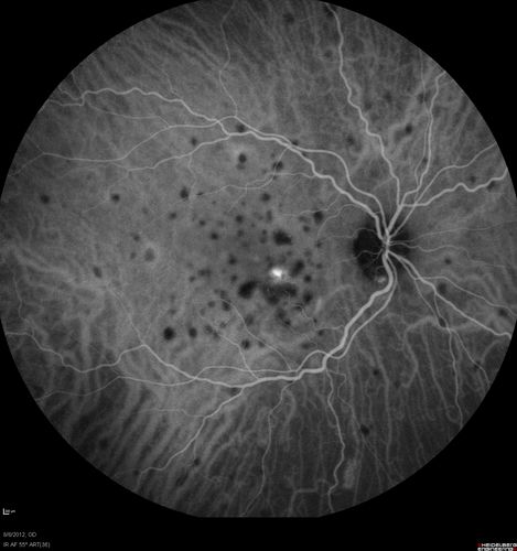 Punctate Inner Choroidopathy - PIC and Choroidal Neovascular Membrane - Right Eye - ICG Angiogram
34-year-old woman with a change in vision in the right eye about eight days ago.  Her vision was hazy and she saw waviness in the vision.  She does have a history of aches and pains and she was diagnosed with Sjogrenâ€™s and 2 months ago she had some fevers and some sinus drainage and that went on for about two months.  She is a moderate myope.    OD 20/25, OS 20/20.   
