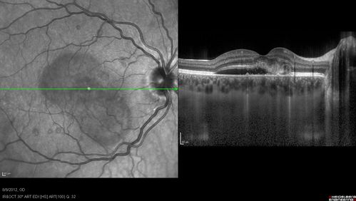 Punctate Inner Choroidopathy - PIC and Choroidal Neovascular Membrane - Right Eye - SD OCT
34-year-old woman with a change in vision in the right eye about eight days ago.  Her vision was hazy and she saw waviness in the vision.  She does have a history of aches and pains and she was diagnosed with Sjogrenâ€™s and 2 months ago she had some fevers and some sinus drainage and that went on for about two months.  She is a moderate myope.    OD 20/25, OS 20/20.   
