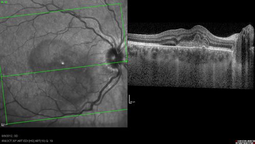 Punctate Inner Choroidopathy - PIC and Choroidal Neovascular Membrane - Right Eye - SD OCT
34-year-old woman with a change in vision in the right eye about eight days ago.  Her vision was hazy and she saw waviness in the vision.  She does have a history of aches and pains and she was diagnosed with Sjogrenâ€™s and 2 months ago she had some fevers and some sinus drainage and that went on for about two months.  She is a moderate myope.    OD 20/25, OS 20/20.   
