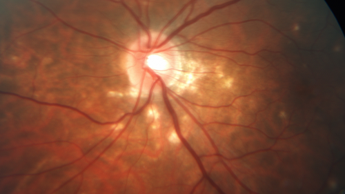 Punctate Inner Choroidopathy - New CNVM right eye
42 year old female with recent vision loss in the right eye - Right eye is 20/80 - Vision improved to 20/16 with Ranabizumab injections over 3 months
