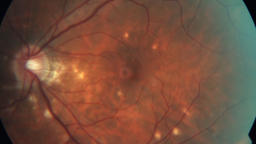 Punctate Inner Choroidopathy - New CNVM right eye
42 year old female with recent vision loss in the right eye - Right eye is 20/80 - Vision improved to 20/16 with Ranabizumab injections over 3 months
