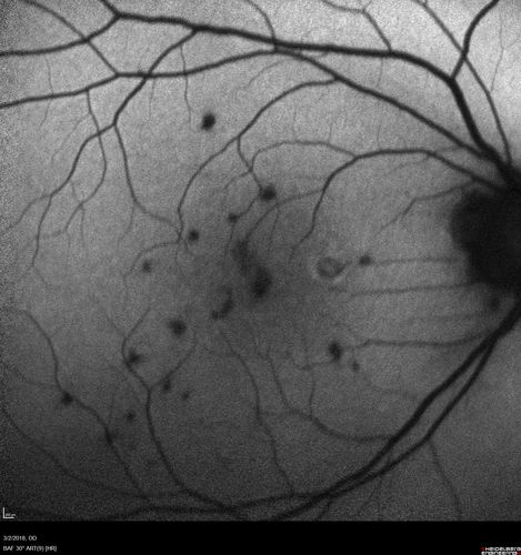 Punctate Inner Choroidopathy - New CNVM right eye
42 year old female with recent vision loss in the right eye - Right eye is 20/80 - Vision improved to 20/16 with Ranabizumab injections over 3 months
