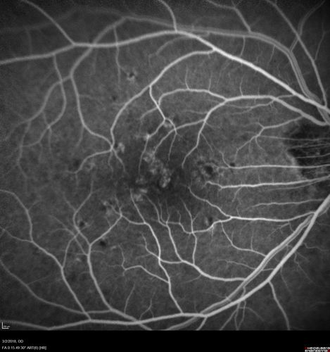 Punctate Inner Choroidopathy - New CNVM right eye
42 year old female with recent vision loss in the right eye - Right eye is 20/80 - Vision improved to 20/16 with Ranabizumab injections over 3 months
