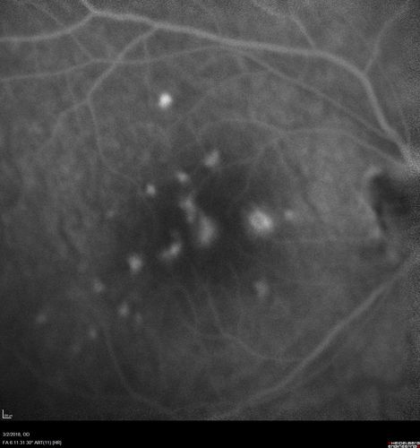 Punctate Inner Choroidopathy - New CNVM right eye
42 year old female with recent vision loss in the right eye - Right eye is 20/80 - Vision improved to 20/16 with Ranabizumab injections over 3 months
