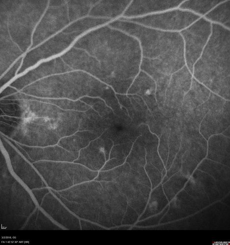 Punctate Inner Choroidopathy - New CNVM right eye
42 year old female with recent vision loss in the right eye - Right eye is 20/80 - Vision improved to 20/16 with Ranabizumab injections over 3 months
