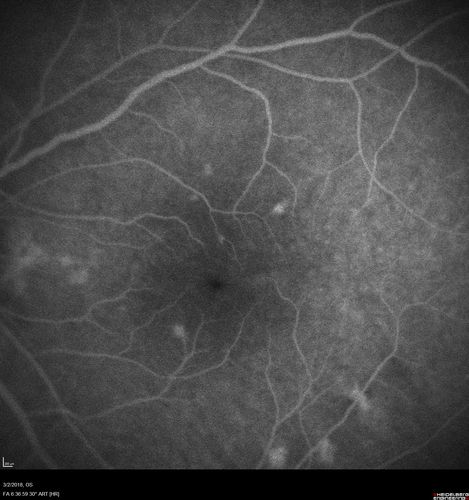 Punctate Inner Choroidopathy - New CNVM right eye
42 year old female with recent vision loss in the right eye - Right eye is 20/80 - Vision improved to 20/16 with Ranabizumab injections over 3 months
