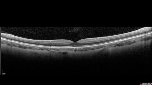 Punctate Inner Choroidopathy - New CNVM right eye
42 year old female with recent vision loss in the right eye - Right eye is 20/80 - Vision improved to 20/16 with Ranabizumab injections over 3 months
