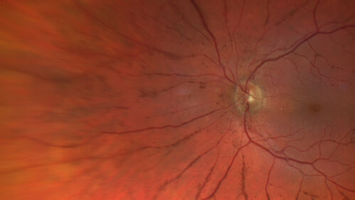 Posterior Pigment Dispersion Syndrome
81 year old man with cataract surgery 30 years ago and normal vision who had bilateral vitrectomy for dense floaters and has pigment on his IOL surface and all over the retina (but not on the cornea) VA 20/25 OU
