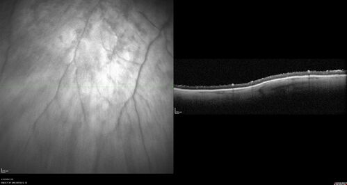 Posterior Pigment Dispersion Syndrome
81 year old man with cataract surgery 30 years ago and normal vision who had bilateral vitrectomy for dense floaters and has pigment on his IOL surface and all over the retina (but not on the cornea) VA 20/25 OU

