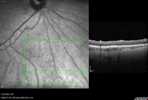 Posterior Pigment Dispersion Syndrome
81 year old man with cataract surgery 30 years ago and normal vision who had bilateral vitrectomy for dense floaters and has pigment on his IOL surface and all over the retina (but not on the cornea) VA 20/25 OU

