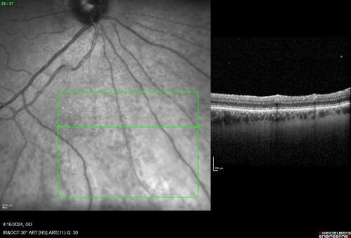 Posterior Pigment Dispersion Syndrome
81 year old man with cataract surgery 30 years ago and normal vision who had bilateral vitrectomy for dense floaters and has pigment on his IOL surface and all over the retina (but not on the cornea) VA 20/25 OU
