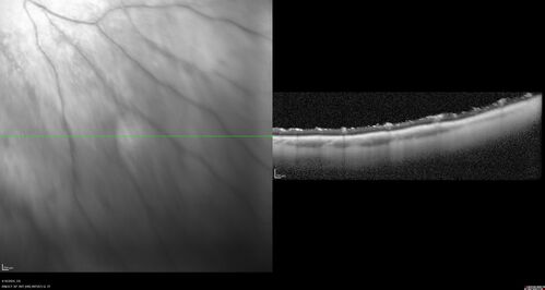 Posterior Pigment Dispersion Syndrome
81 year old man with cataract surgery 30 years ago and normal vision who had bilateral vitrectomy for dense floaters and has pigment on his IOL surface and all over the retina (but not on the cornea) VA 20/25 OU
