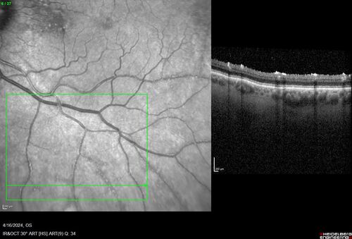 Posterior Pigment Dispersion Syndrome
81 year old man with cataract surgery 30 years ago and normal vision who had bilateral vitrectomy for dense floaters and has pigment on his IOL surface and all over the retina (but not on the cornea) VA 20/25 OU
