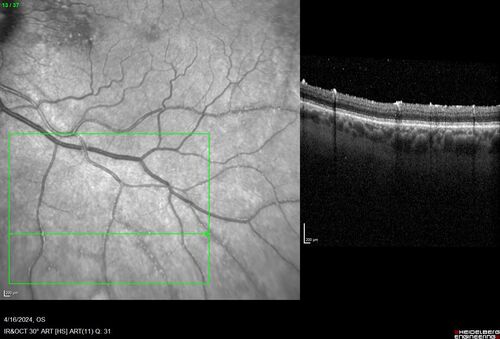 Posterior Pigment Dispersion Syndrome
81 year old man with cataract surgery 30 years ago and normal vision who had bilateral vitrectomy for dense floaters and has pigment on his IOL surface and all over the retina (but not on the cornea) VA 20/25 OU
