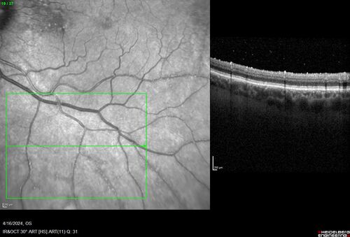Posterior Pigment Dispersion Syndrome
81 year old man with cataract surgery 30 years ago and normal vision who had bilateral vitrectomy for dense floaters and has pigment on his IOL surface and all over the retina (but not on the cornea) VA 20/25 OU

