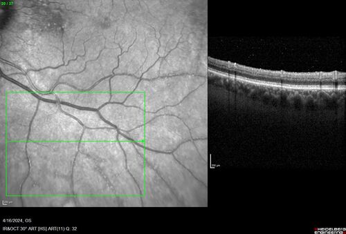 Posterior Pigment Dispersion Syndrome
81 year old man with cataract surgery 30 years ago and normal vision who had bilateral vitrectomy for dense floaters and has pigment on his IOL surface and all over the retina (but not on the cornea) VA 20/25 OU
