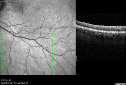 Posterior Pigment Dispersion Syndrome
81 year old man with cataract surgery 30 years ago and normal vision who had bilateral vitrectomy for dense floaters and has pigment on his IOL surface and all over the retina (but not on the cornea) VA 20/25 OU
